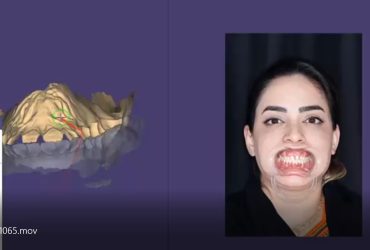 طراحی لبخند با کامپوزیت ونیر