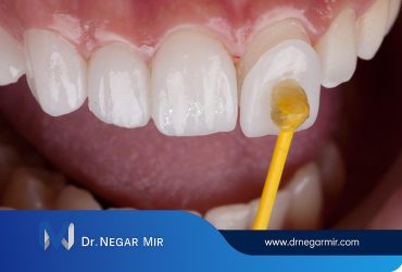 لمینت لبه شیشه ای