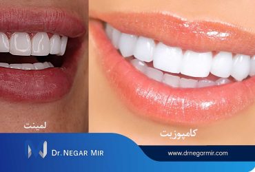 لمینت یا کامپوزیت؟
