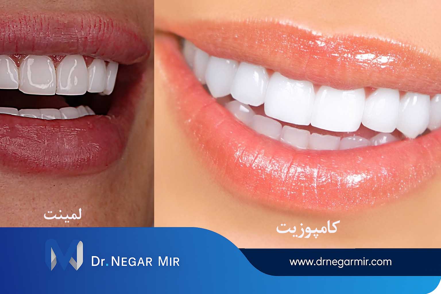 لمینت یا کامپوزیت؟