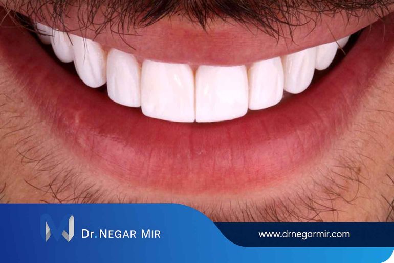 لمینت سرامیکی نیاوران