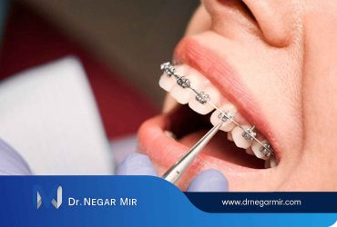 انواع روش های ارتودنسی دندان