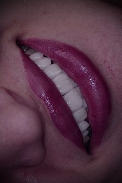 لمینت دندان