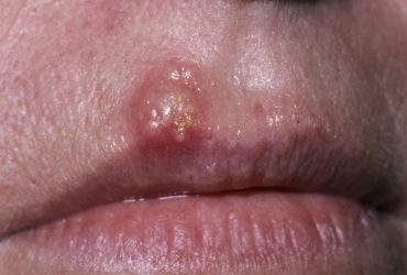 تبخال در دندانپزشکی