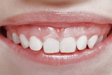 لبخند لثه ای