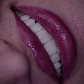 لمینت دندان